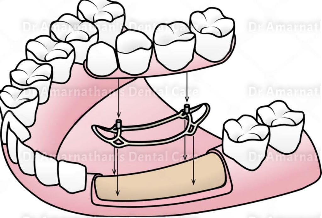 different types of dental implants