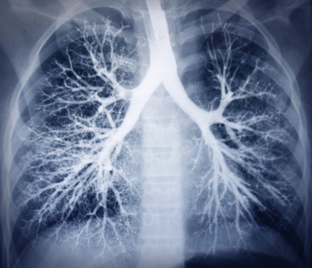 x ray of lungs