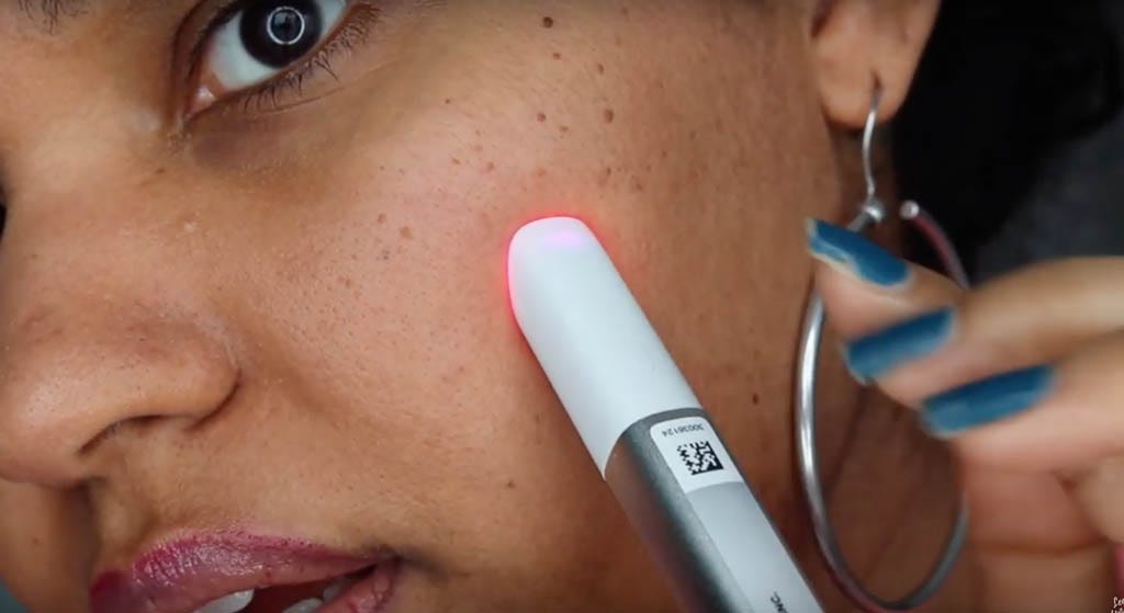 Leesa Unique using Neutrogena Light Therapy Acne Spot Treatment