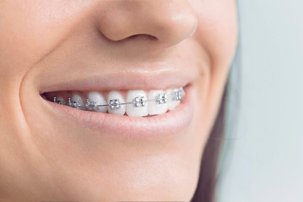 Braces or Aligners Treatment in Mohali — 32 Sparklets | Dentist In Mohali | Best Dentist in Mohali