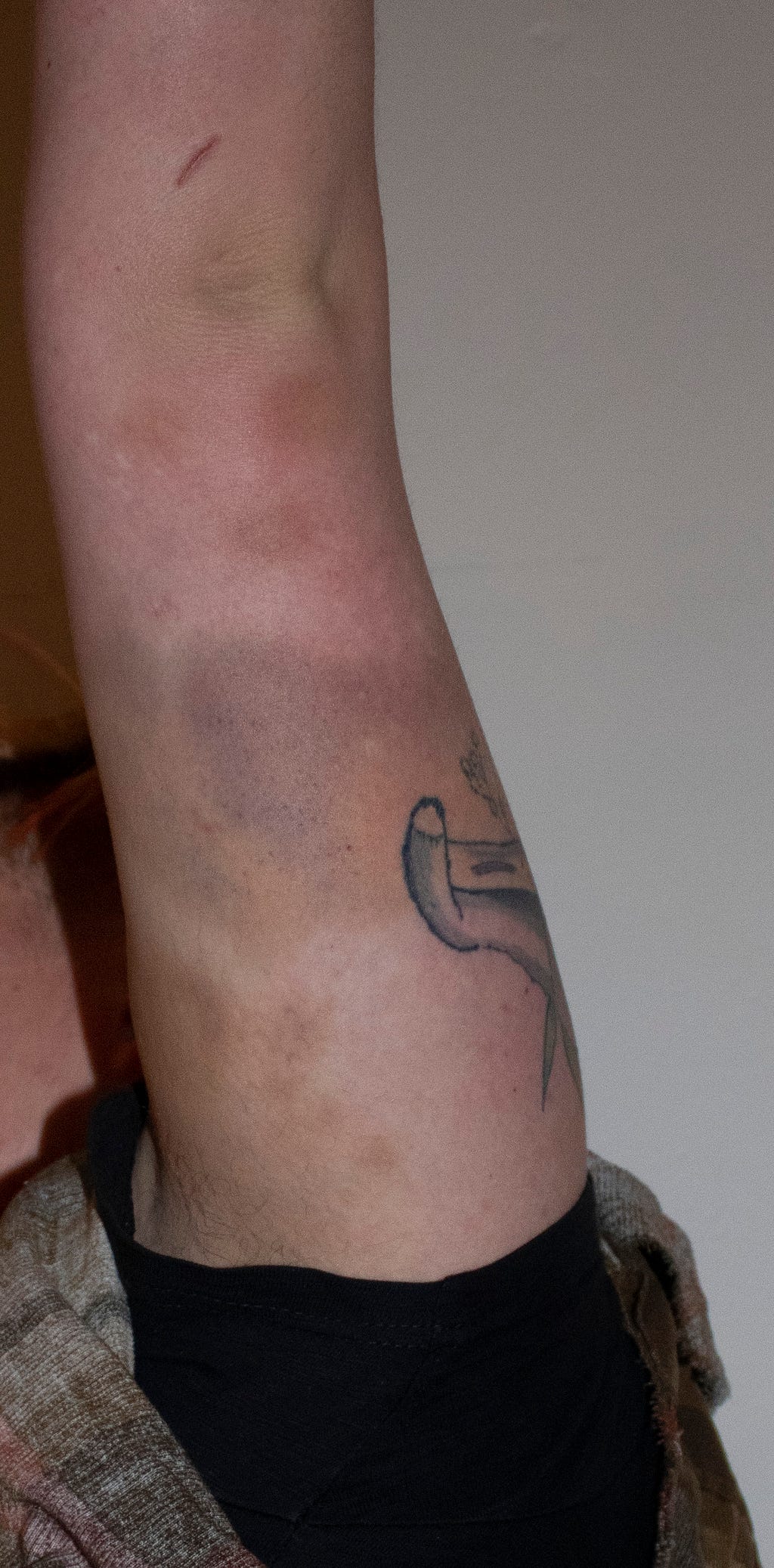 A pale, vertically extended forearm mottled with bruising both in concentrated spots and broad spans of skin, predominately dark or yellowing, with a cut above the straightened elbow and the curve of a tattooed tail visible