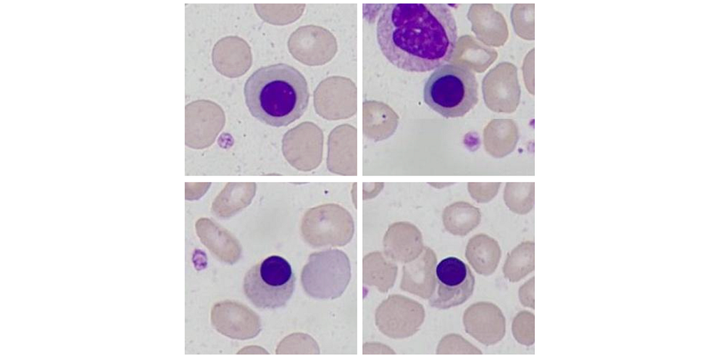Leucoerythroblastic Blood Picture: A Diagnostic Window into Bone Marrow Pathology