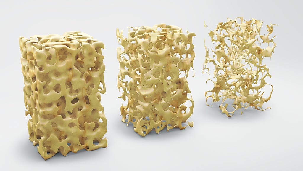 progression of osteoporosis