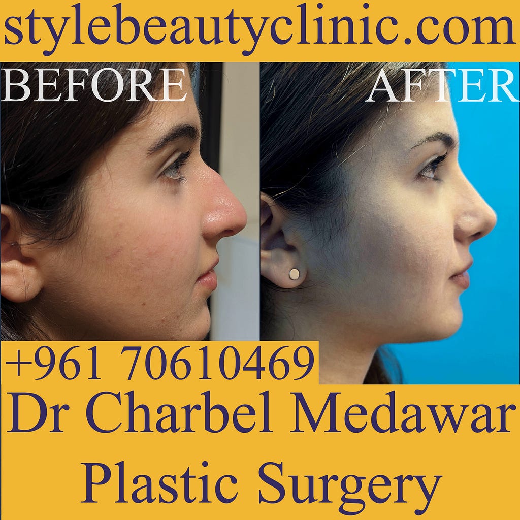 rhinoplasty lebanon dr charbel medawar