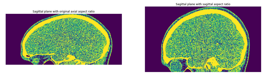 A set of still images showing the sagittal view of a cranial CT scan with the pixel aspect ratio accurately adjusted (left) and without the pixel aspect ratio adjusted (right).