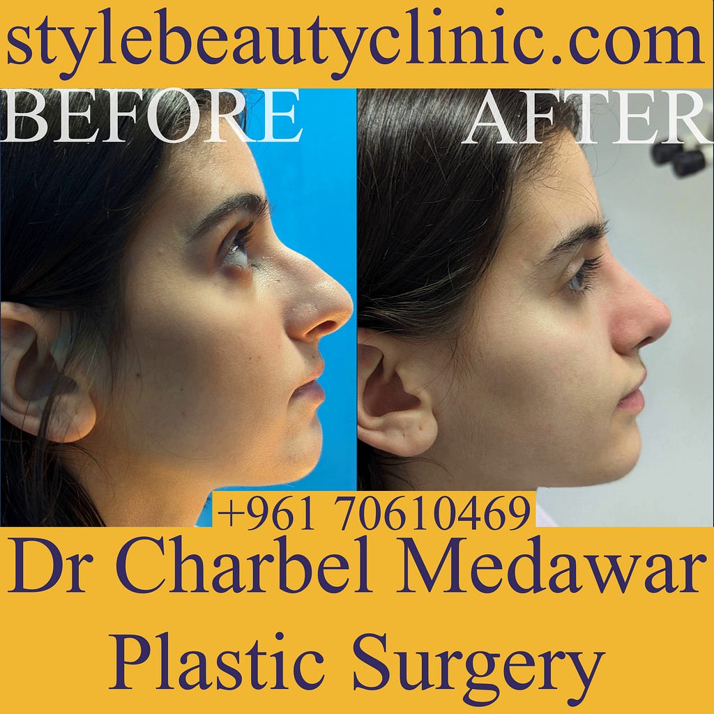 top nose plastic surgeon lebanon dr charbel medawar