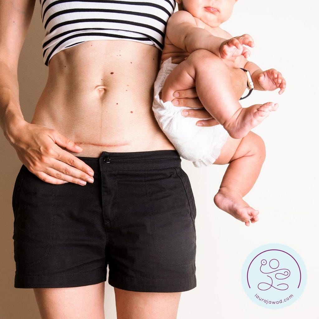 Belly of white woman holding her baby, with a visible C-section scar.