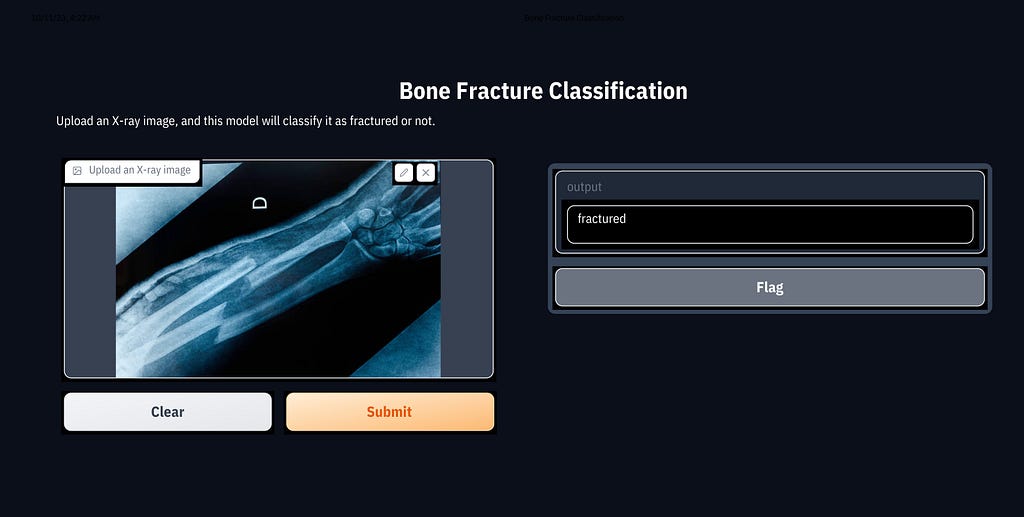 CNN model to predict if bone is broken or not