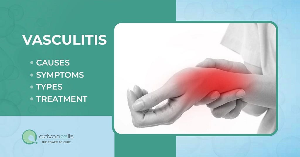 Vasculitis: Types, Symptoms, Diagnosis, and Treatment