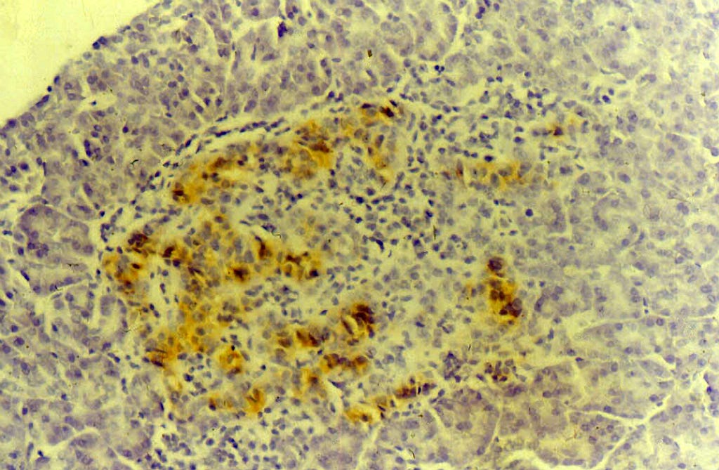 A photomicrograph of pancreatic cells. Looks like frog spawn on yellow background with brown smears.