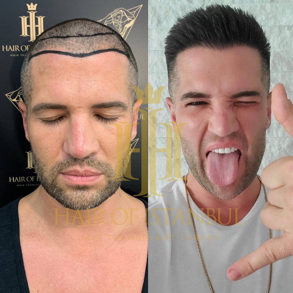 before-and-after-hair-transplant-turkey-hair-of-istanbul