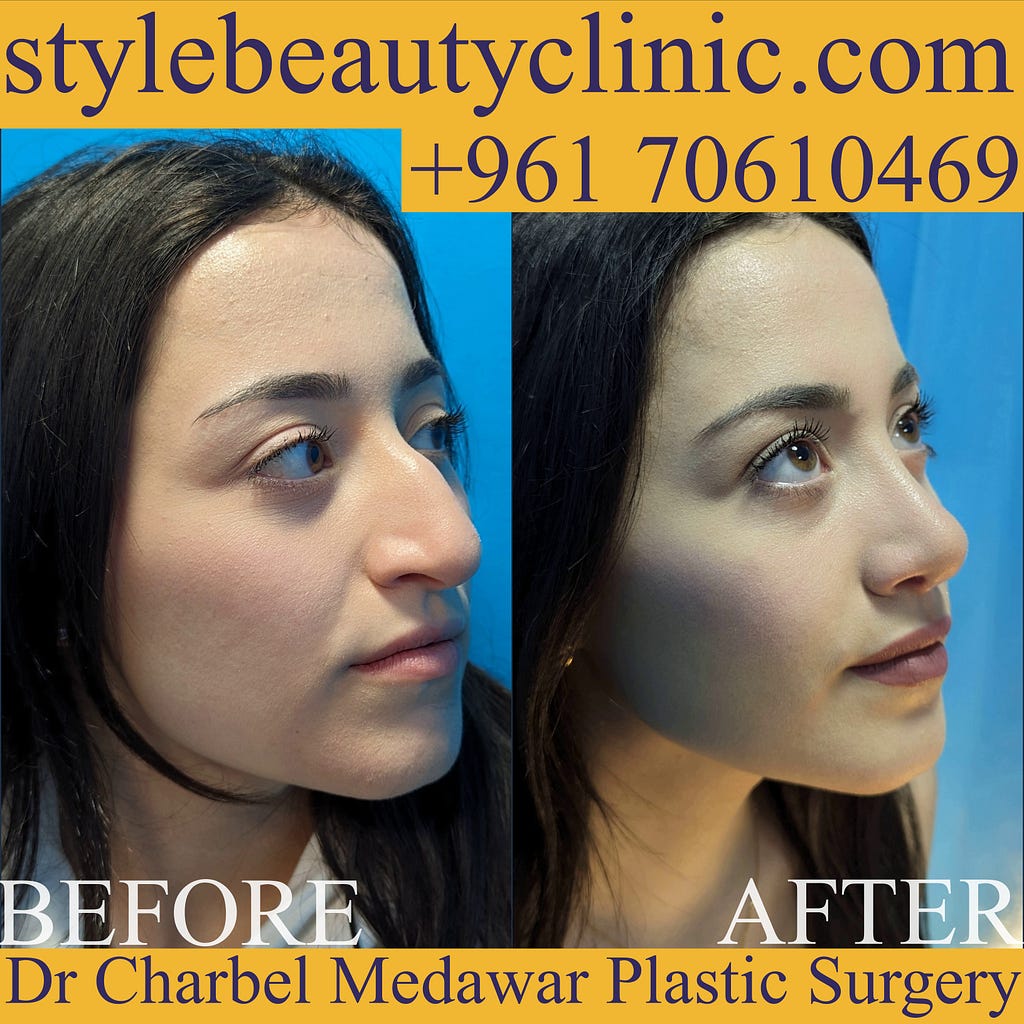 best rhinoplasty in lebanon dr charbel medawar