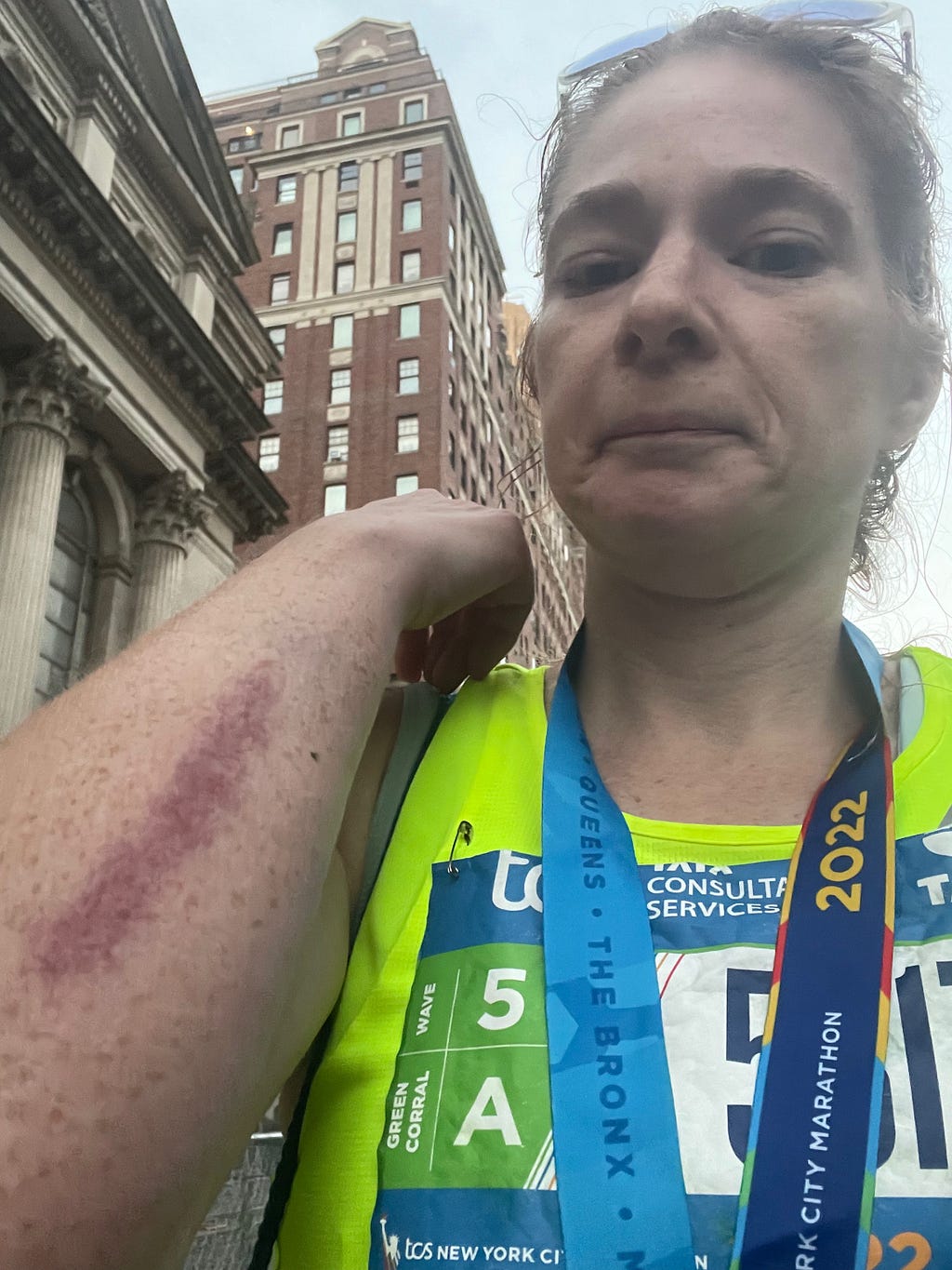 The road rash after cleaning my arm off with some water at the medic tent at the NYC marathon in 2022
