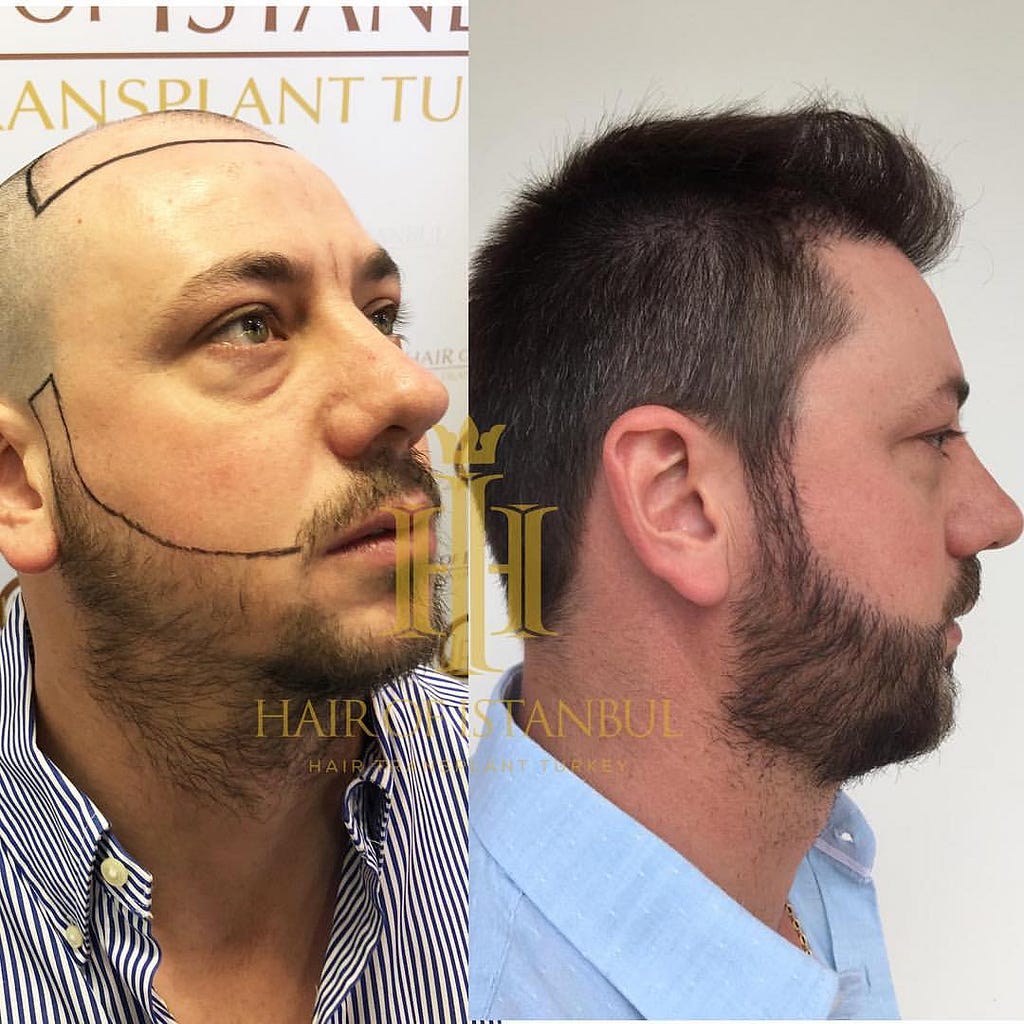 before-and-after-beard-transplant-hair-of-istanbul