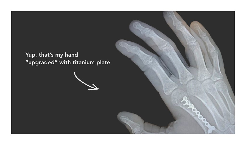 Xray of my broken hand with titanium plate inside and caption “yup, that’s my hand upgraded with titanium plate”
