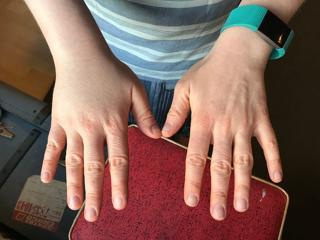 A shot of two hands, the one on the left swollen compared with the one on the right