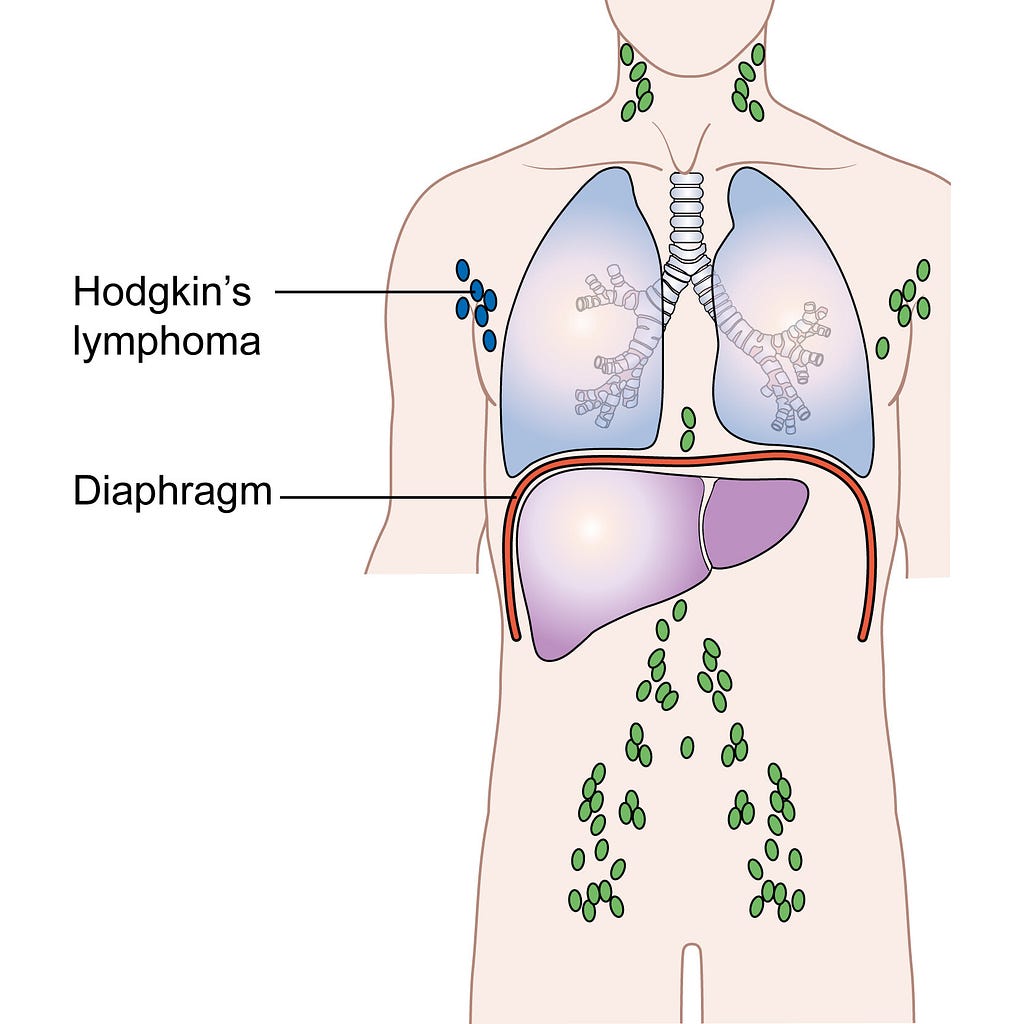 Childhood Lymphoma