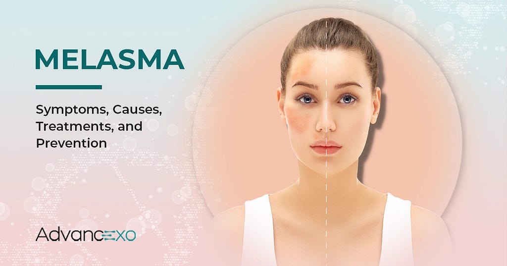 Melasma: Symptoms, Causes, Treatments, and Prevention