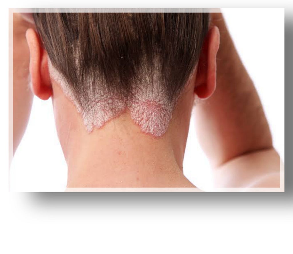 Suffering from psoriasis?There are several home remedies