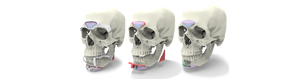 Three skulls showing locations of bone grafting/shaving for gender affirming facial surgeries