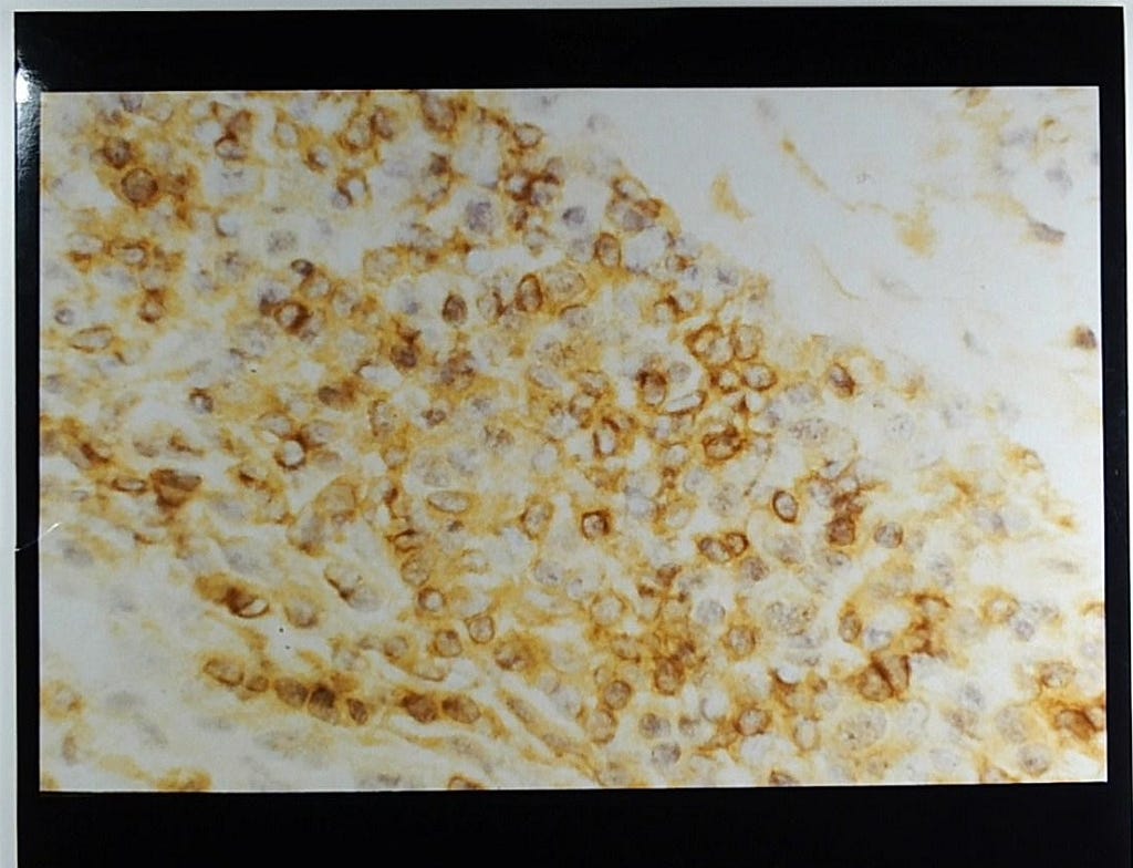 Synovial membrane in a patient with RA credit: Photo credit: Part of Kennedy Trust for Rheumatology Research Collection SA/KET (copyright transferred to Wellcome). Microscopic image of synovial membrane. Colours of the image are white, yellow and brown.