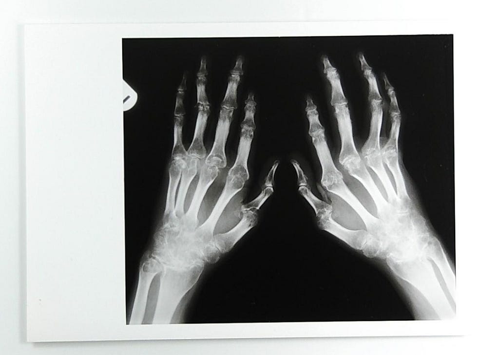 An x-ray of two hands that shows some joint deformity caused by rheumatoid arthritis.