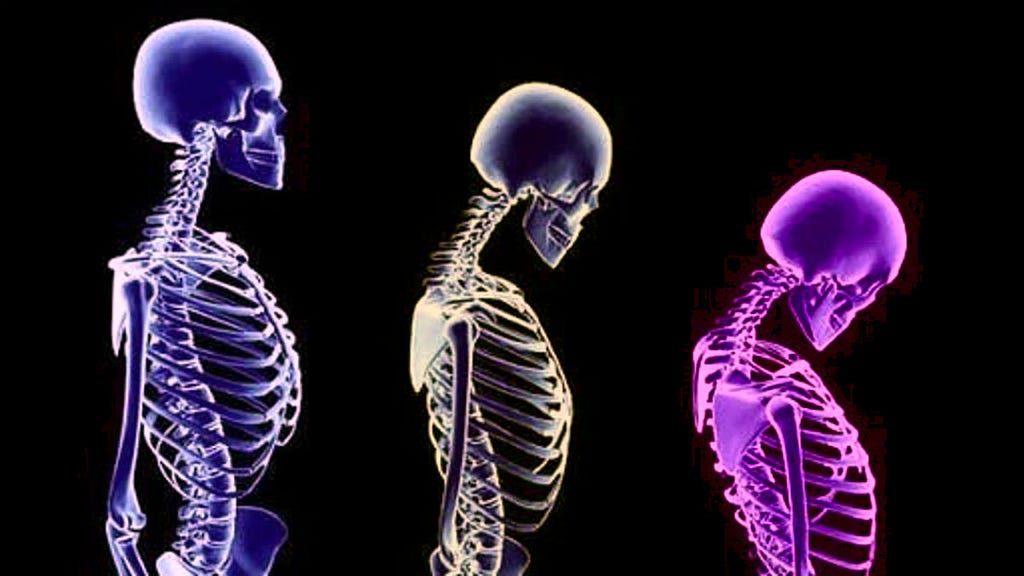 What is Osteoporosis?