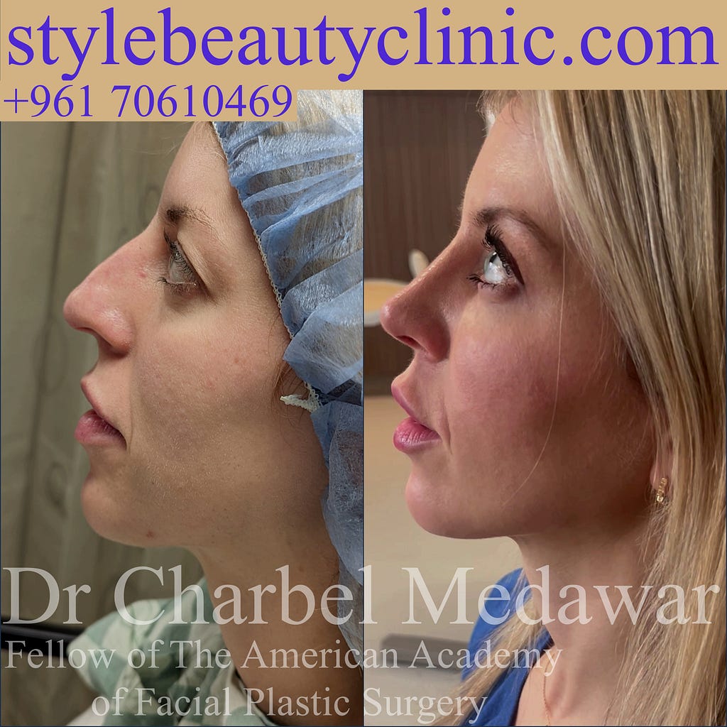 heidi bitton rhinoplasty by dr Charbel Medawar