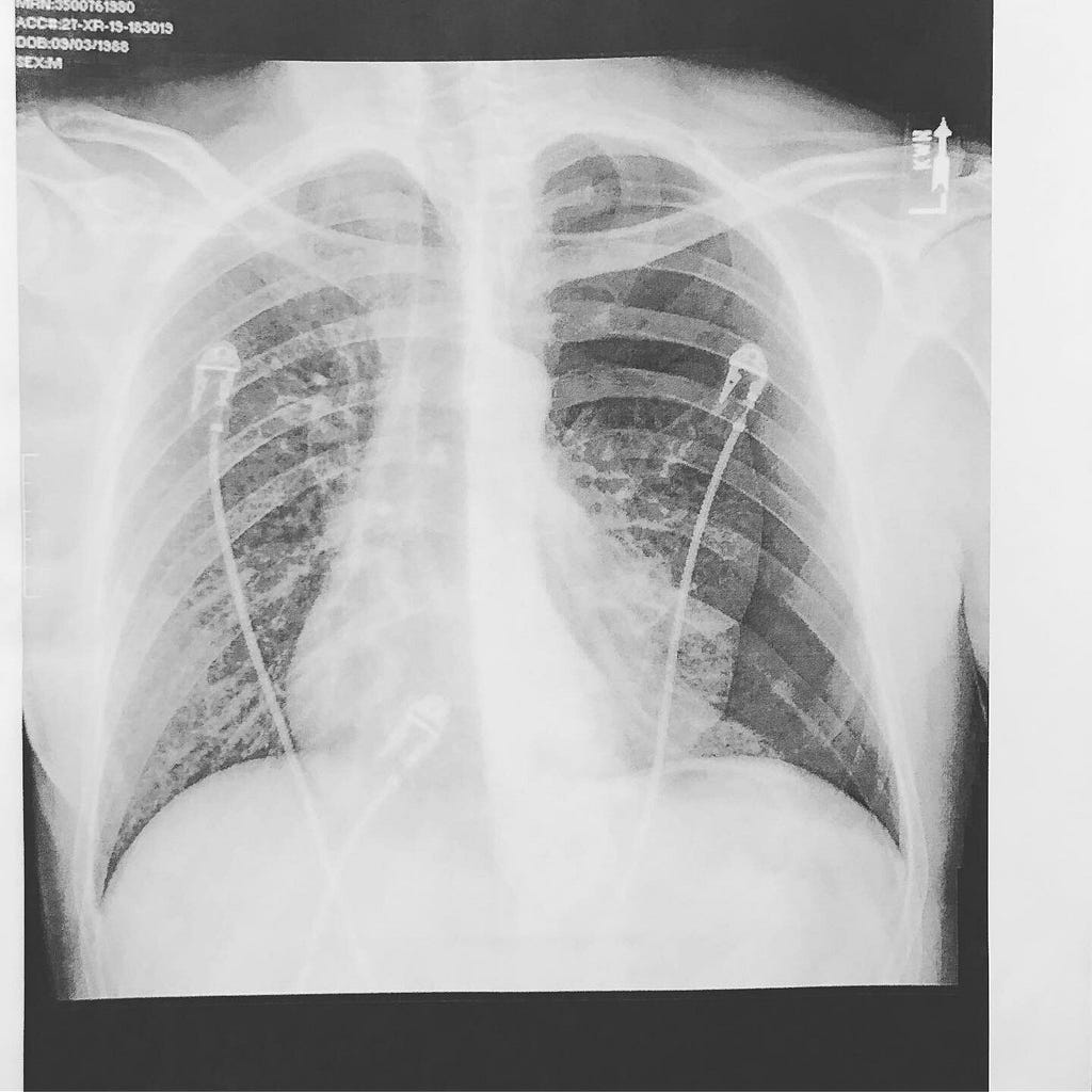 X-ray image of my collapsed lung