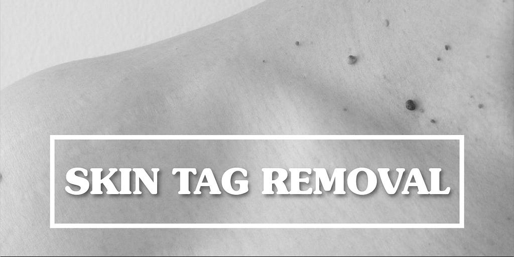 skin tags above collar bone