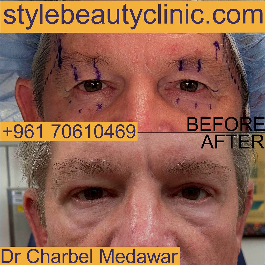 dr charbel medawar browlift