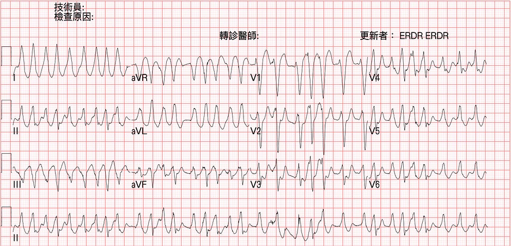 這是什麼扭曲變形的ECG?