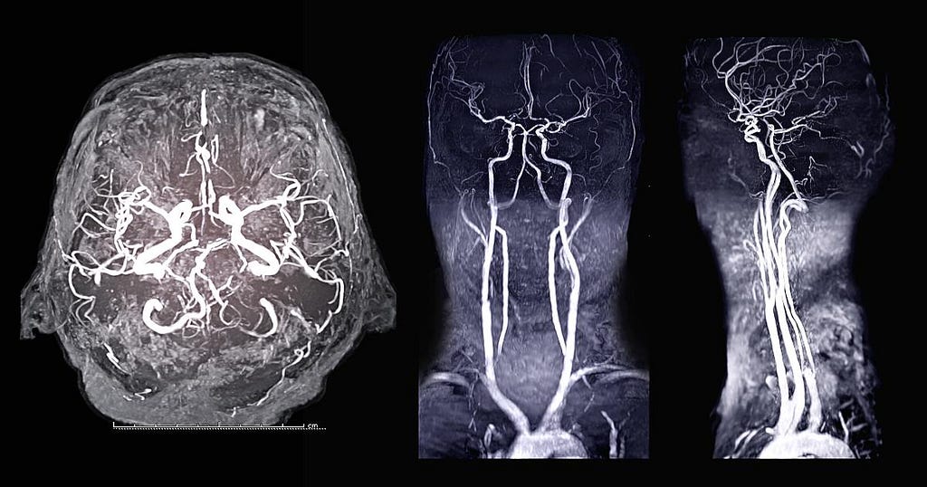 MRI contrast agent angiography scan of the brain axial, sagittal and coronal view. Copyright 2023 MRIPETCTSOURCE