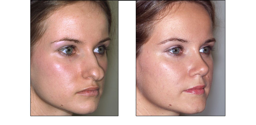 Before and after photographs of a rhinoplasty patient.