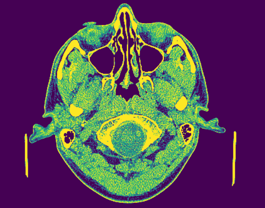 A high-contrast image of the axial plane of a cranial CT scan in shades of yellow, green, blue, and purple.