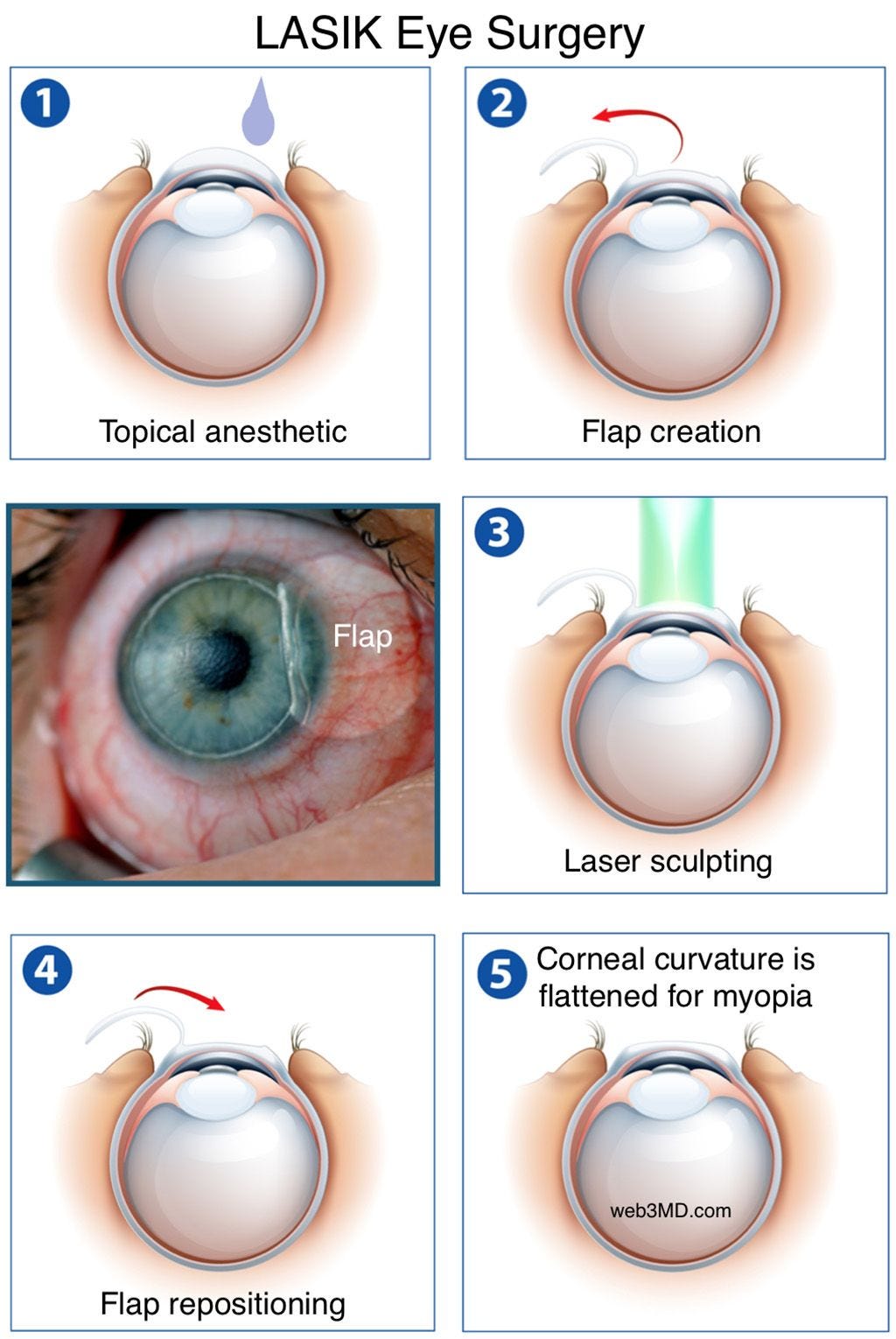 Process of Lasik surgery of a myopia patient