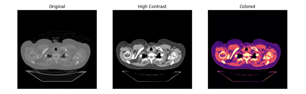 Three versions of the same chest CT scan in the axial plane; the first (left) is the original, in gray tones and low contrast, the second (middle) is in gray tones with increased contrast, and the third (right) has increased contrast and is colored with the ‘magma’ colormap from matplotlib.