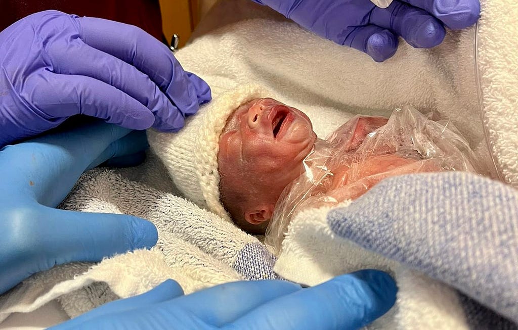 Newborn child letting out a scream surrounded by medical staff hands in gloves.