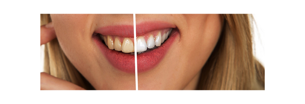 A woman smiling with her teeth exposed. Half of the image is with good oral hygeine the other half is a stained set of teeth