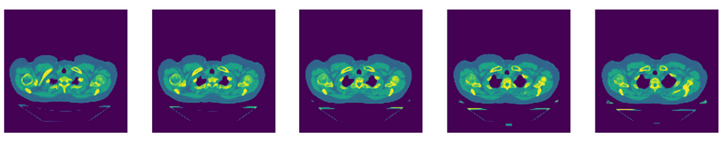 A horizontal row of five sequential chest CT images in the axial plane in the default colormap of matplotlib (yellows, greens, and blues).