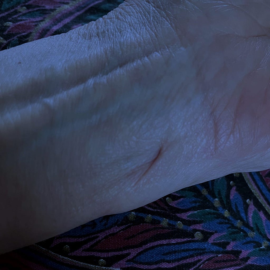 Scar on underside of wrist