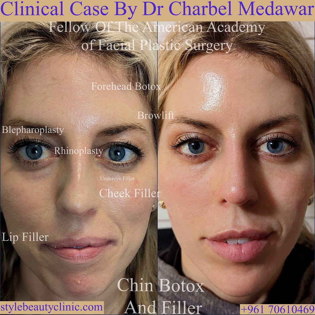 heidi bitton plastic surgery dr charbel medawar