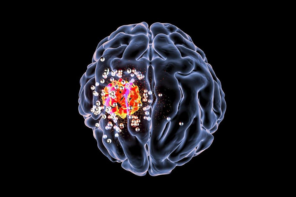 Astrocytoma Brain Tumour