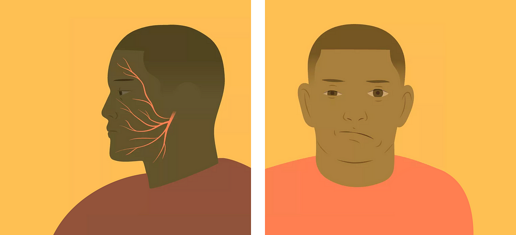 Two diagrams of a face. First highlighting the facial nerve. Second with an asymmetrical face, with the right side drooping.