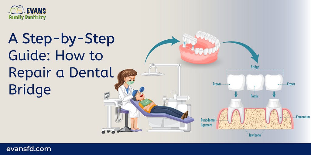 How to Repair a Dental Bridge