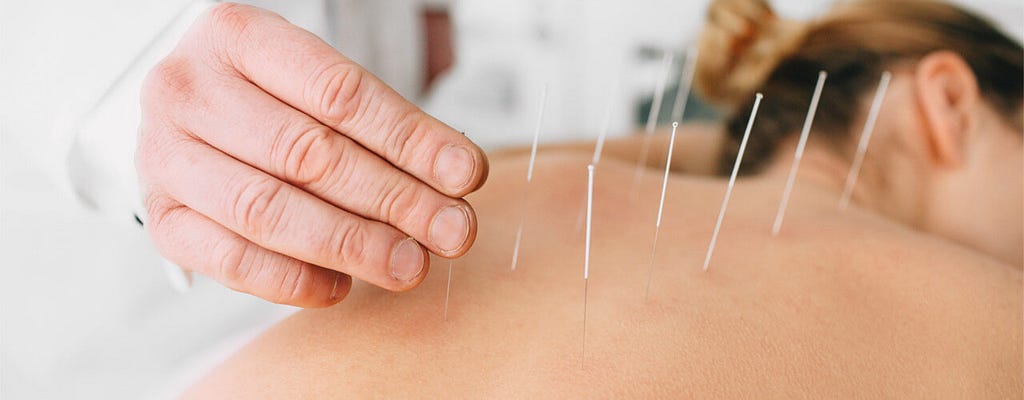 acupuncture for lower back pain