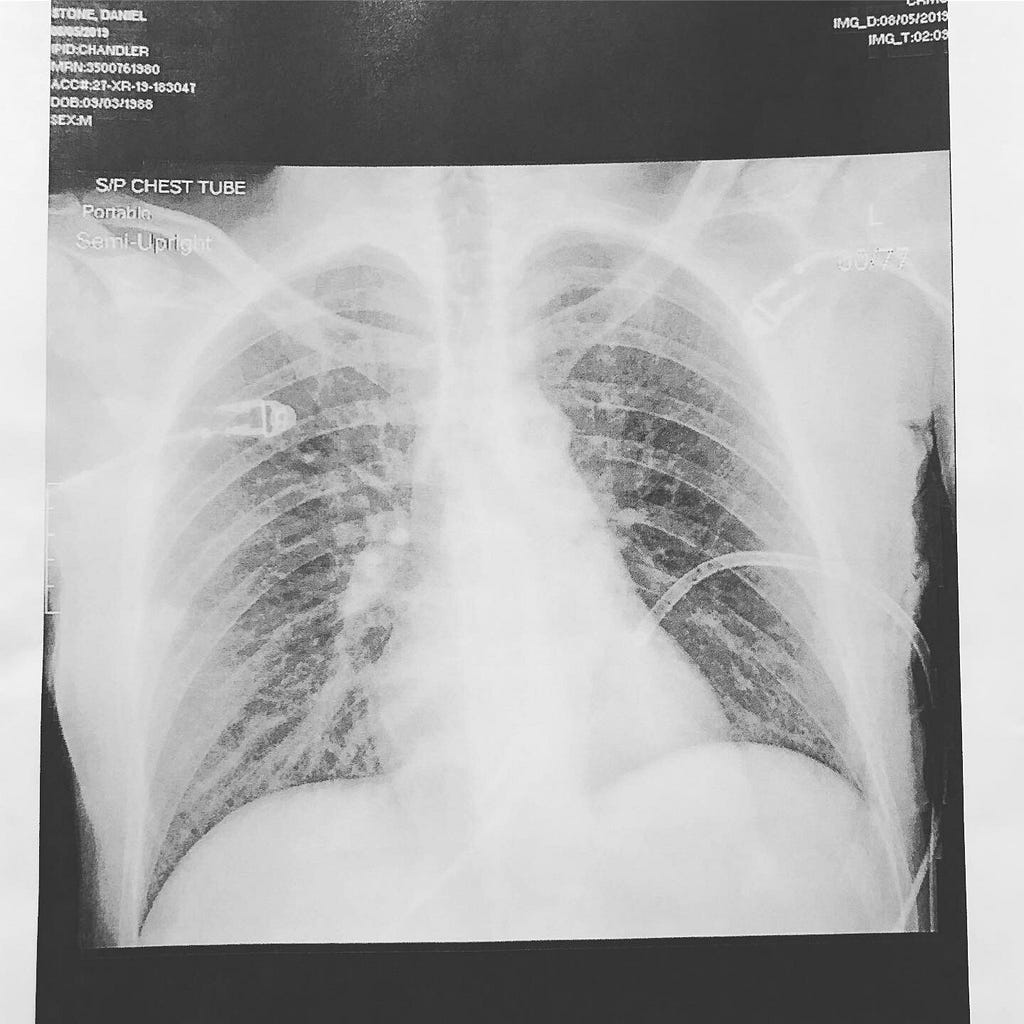 X-ray image of my lung re-inflated