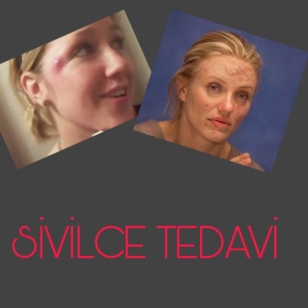Sivilcelerin tedavisi için Sivilcelerin tedavisi için
