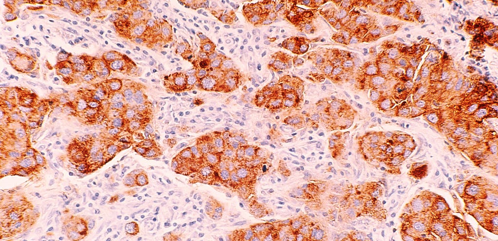 A red and orange stained view of tissue cells taken from the body.