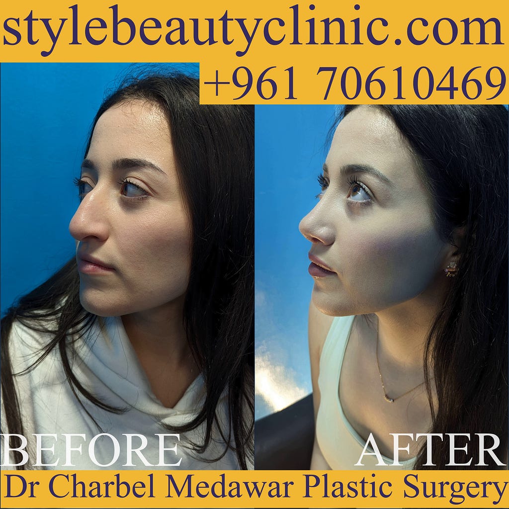 best nose plastic surgeon in lebanon